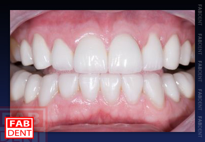 odbudowa poĹamanych zębów warszawa