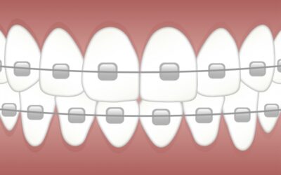 Rodzaje aparatów ortodontycznych stałych